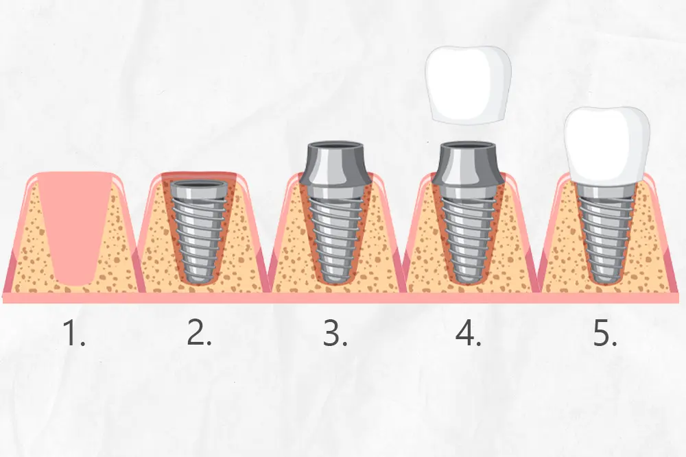 From Surgery to Smile: Understanding the Dental Implant Healing Stages