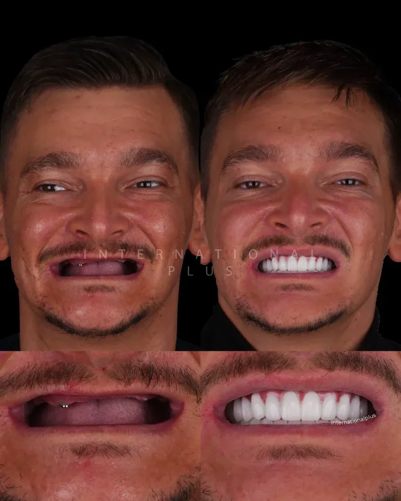 What Are Full Mouth Dental Implant Solutions