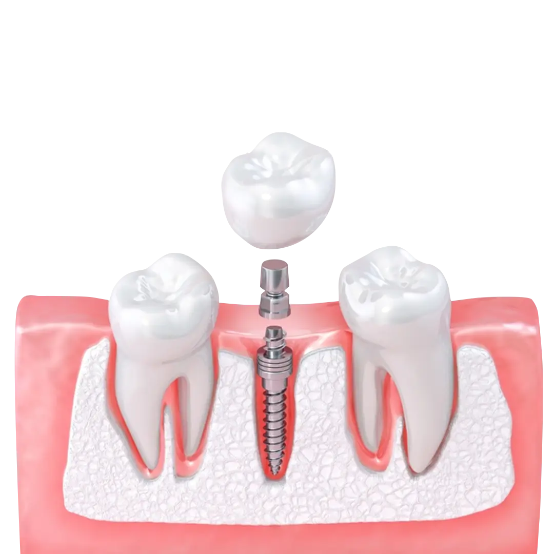 Advantages of Mini Dental Implants Advantages of Mini Dental Implants