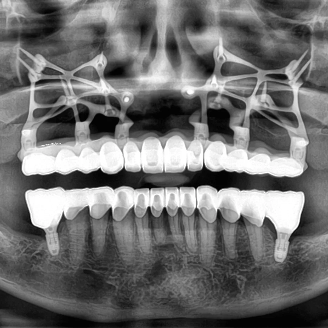 After Mini Dental Implants After Mini Dental Implants