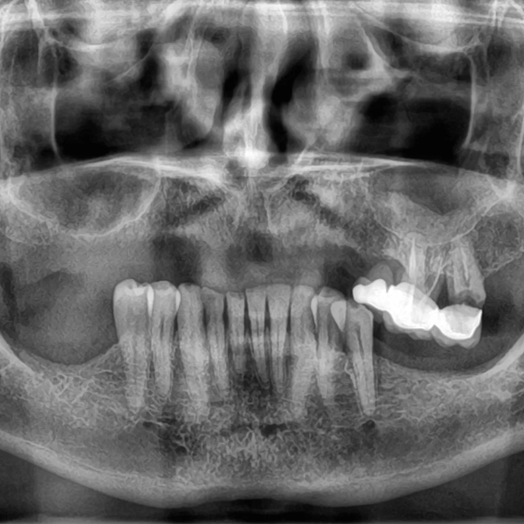 Before Mini Dental Implants Before Mini Dental Implants