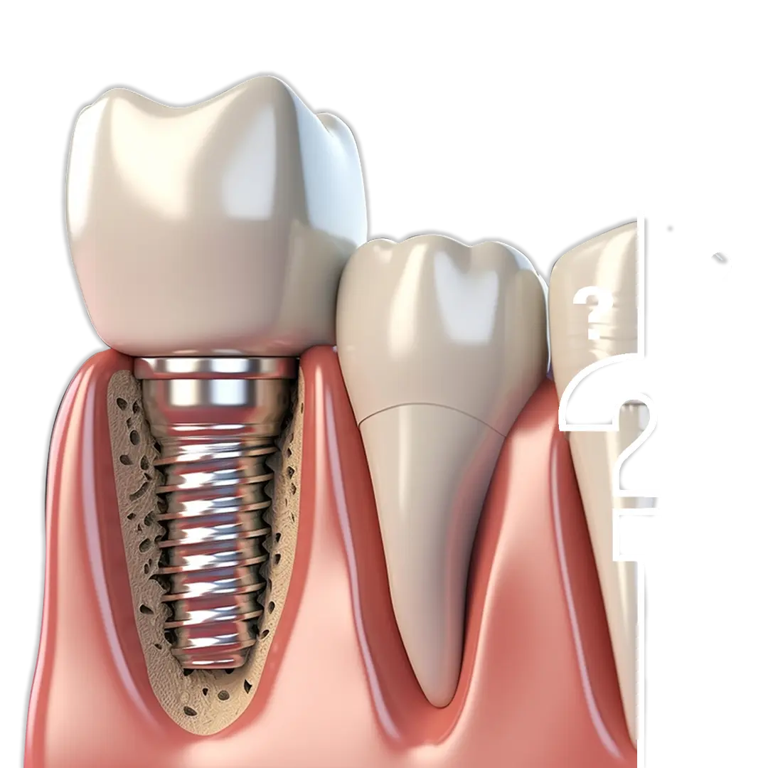 How Much Do Mini Implants Cost in Istanbul How Much Do Mini Implants Cost in Istanbul