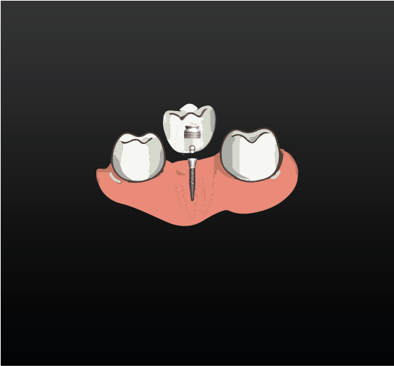 Mini Implants