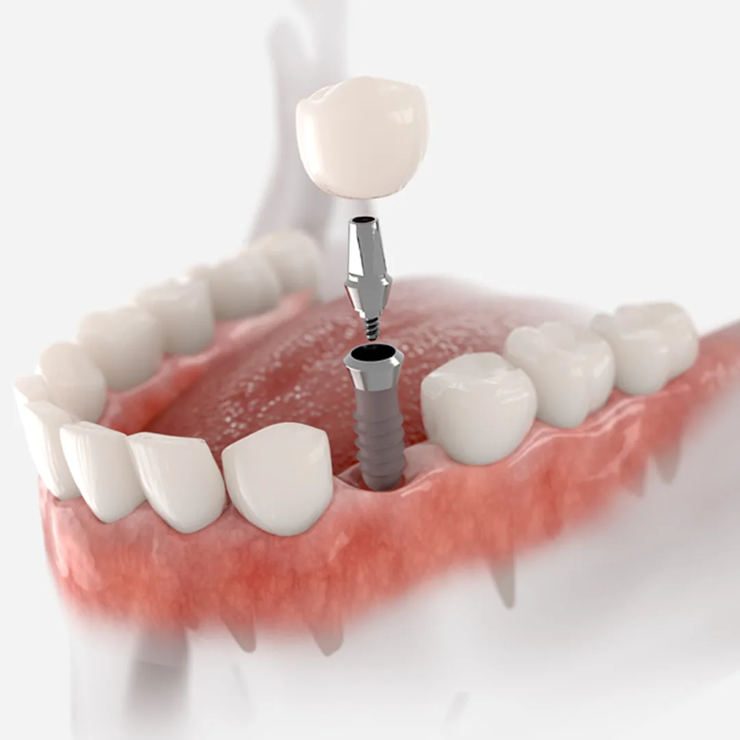 Mini-Implants-in-Istanbul-Turkey