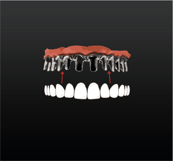 Toronto Dental Bridge