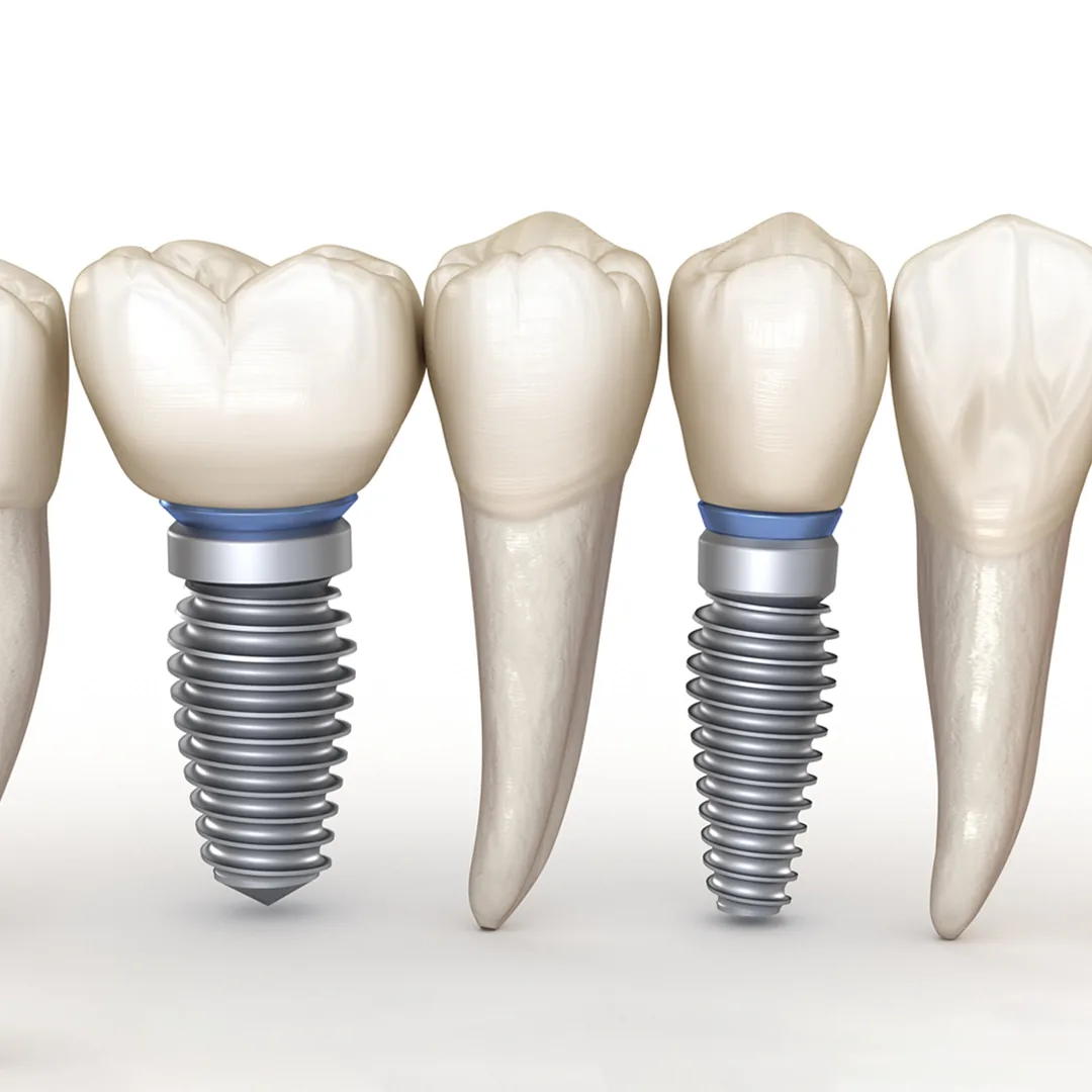What Are Mini Dental Implants What Are Mini Dental Implants