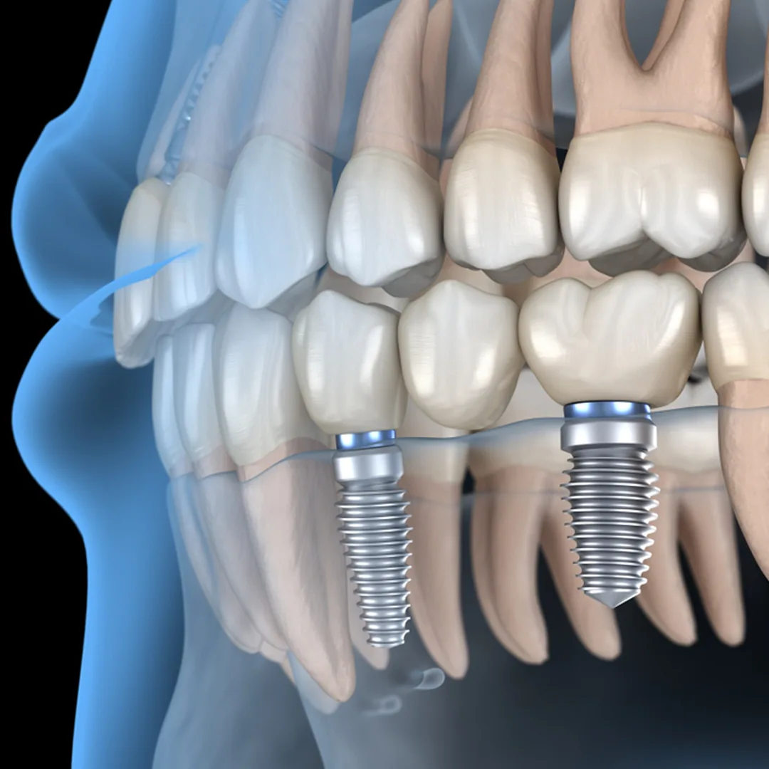 Why Choose Us for Mini Implants in Istanbul, Turkey Why Choose Us for Mini Implants in Istanbul, Turkey