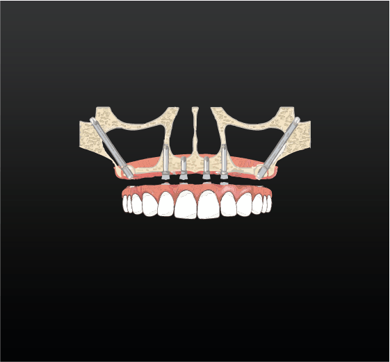 Zygoma Implant