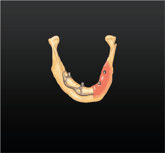 Custom Implant