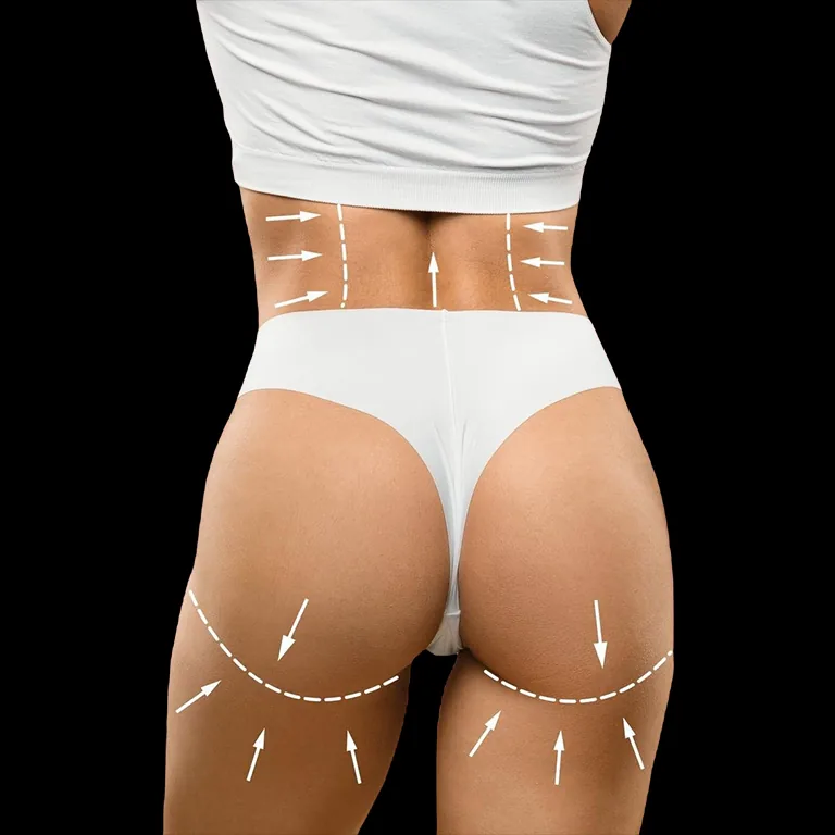 Brazilian Butt Lift (BBL) (Before After)