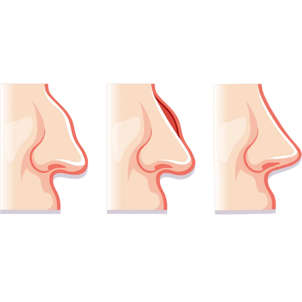 Ce este rinoplastia
