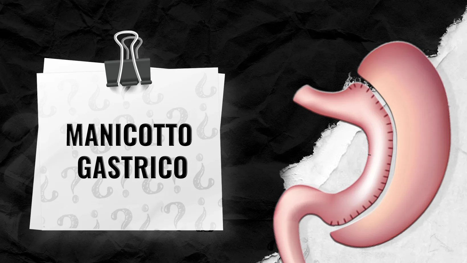 Chi-si-qualifica-per-la-manica-gastrica