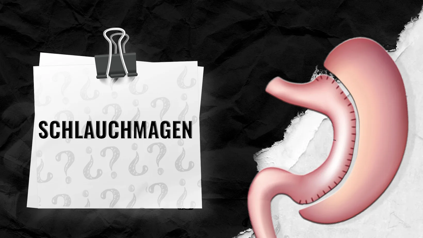 Fur-wen-ist-eine-Magenverkleinerung-geeignet