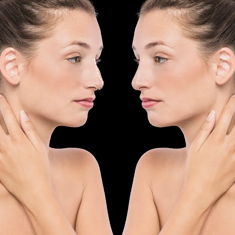 Rhinoplasty (Before After)