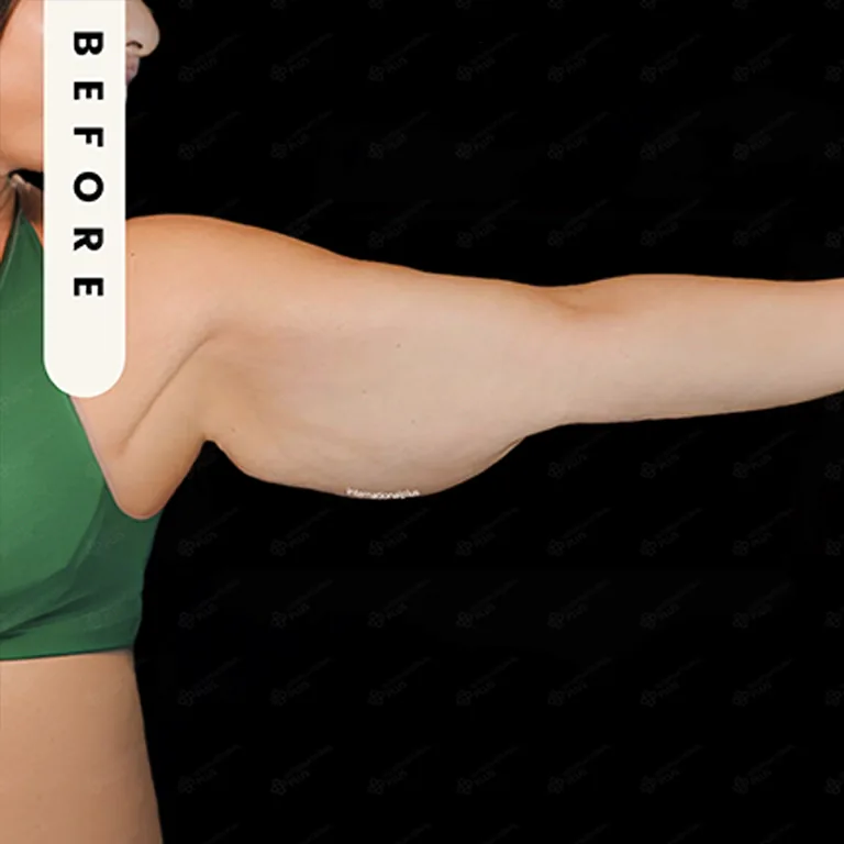 arm lift before after 7