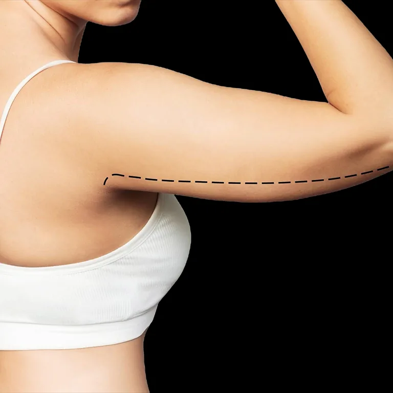 Arm Lift (Before After)