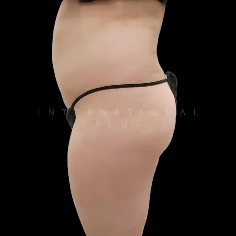 brazilian-butt-lift-bbl-before-after-1 brazilian butt lift bbl before after 1