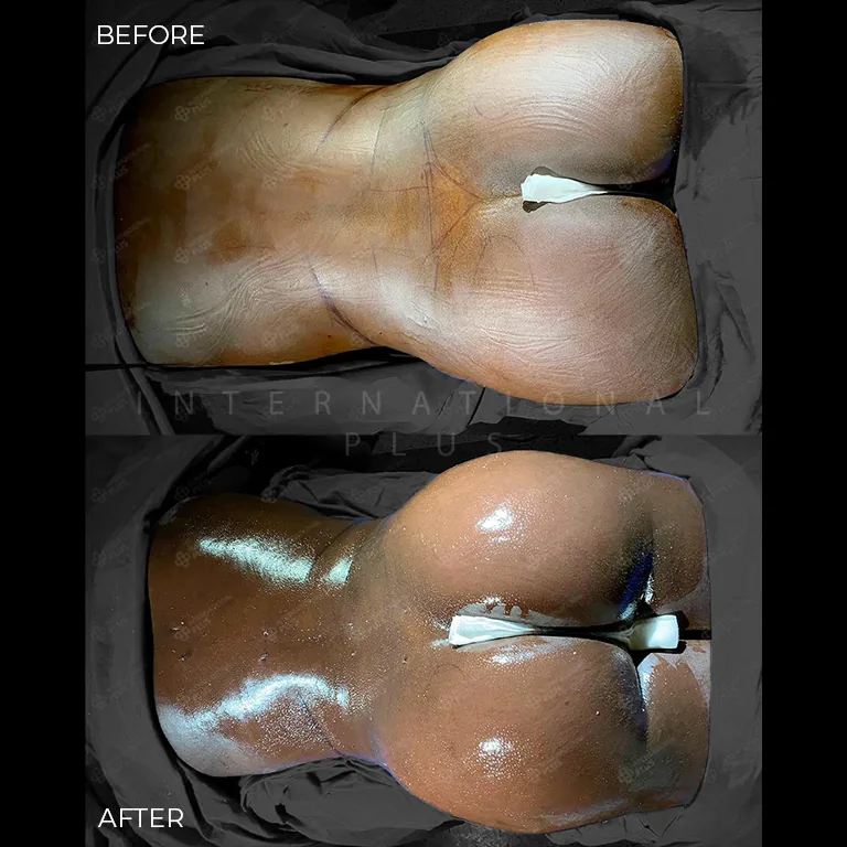 brazilian-butt-lift-bbl-before-after-13 brazilian butt lift bbl before after 13