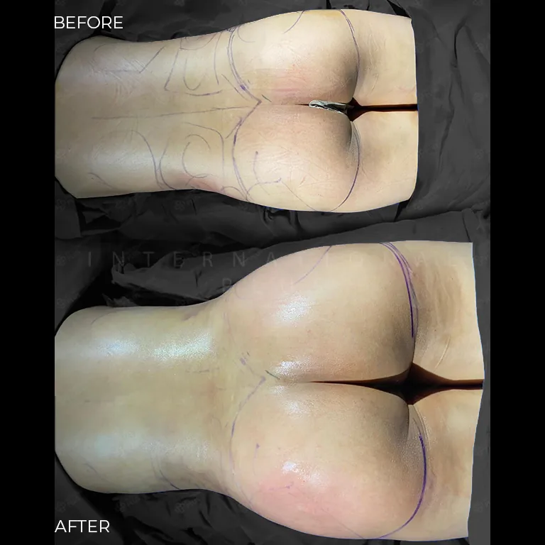 brazilian-butt-lift-bbl-before-after-14 brazilian butt lift bbl before after 14