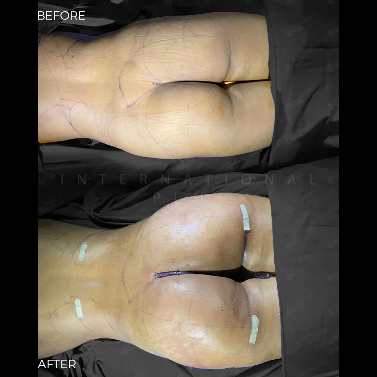brazilian-butt-lift-bbl-before-after-15 brazilian butt lift bbl before after 15