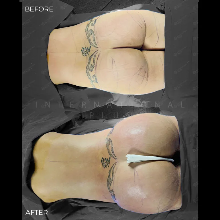 brazilian-butt-lift-bbl-before-after-16 brazilian butt lift bbl before after 16