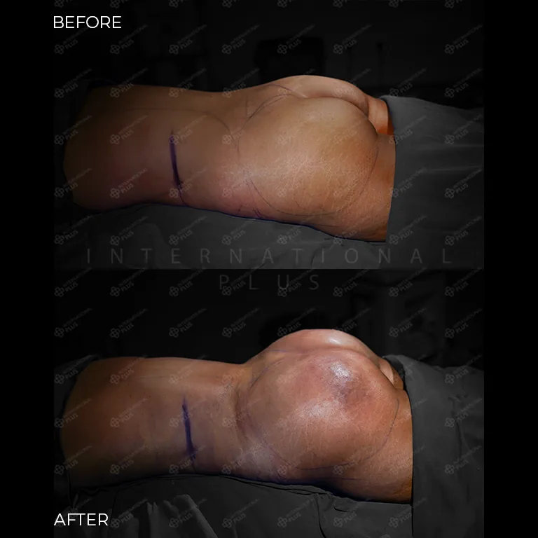 brazilian-butt-lift-bbl-before-after-17 brazilian butt lift bbl before after 17