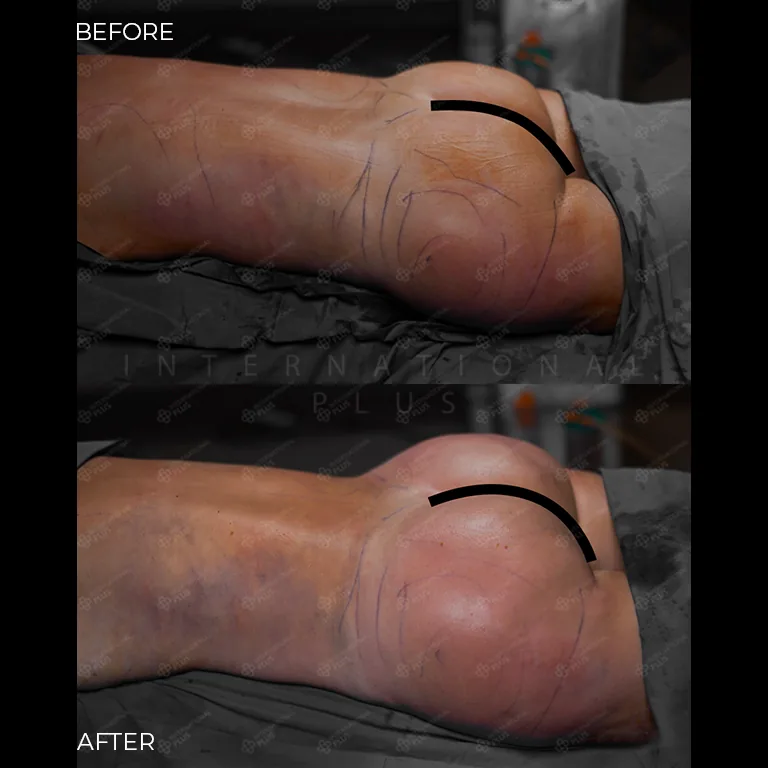 brazilian-butt-lift-bbl-before-after-18 brazilian butt lift bbl before after 18