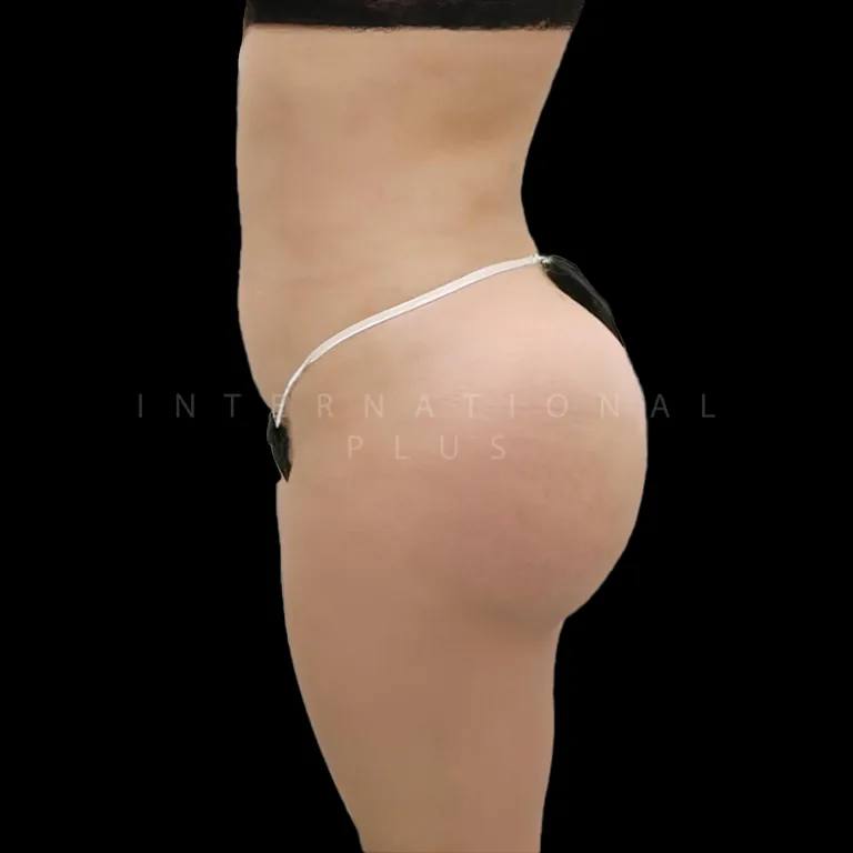 brazilian-butt-lift-bbl-before-after-2 brazilian butt lift bbl before after 2