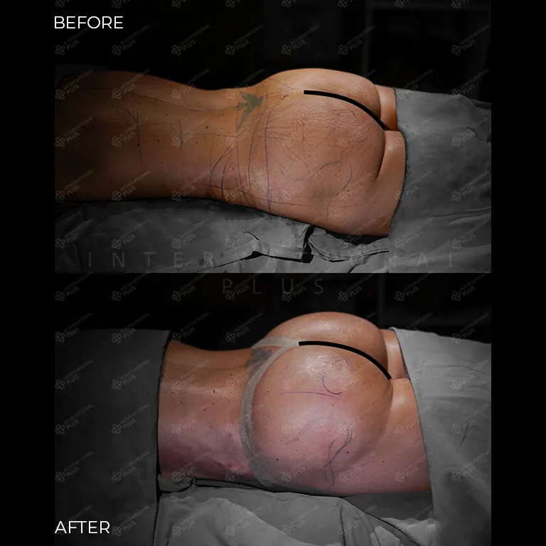 brazilian-butt-lift-bbl-before-after-20 brazilian butt lift bbl before after 20