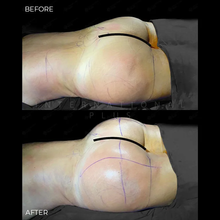 brazilian-butt-lift-bbl-before-after-24 brazilian butt lift bbl before after 24