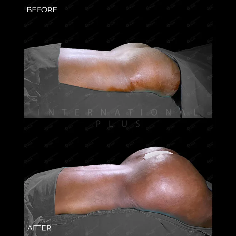 brazilian-butt-lift-bbl-before-after-25 brazilian butt lift bbl before after 25