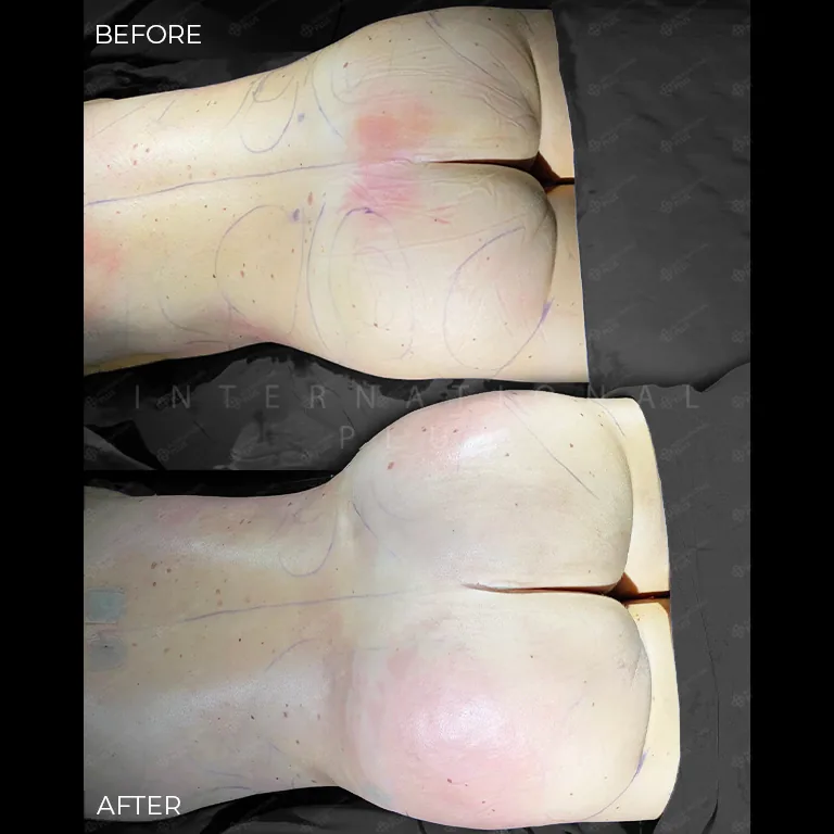 brazilian-butt-lift-bbl-before-after-26 brazilian butt lift bbl before after 26