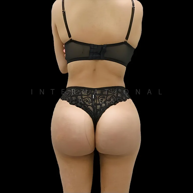 brazilian-butt-lift-bbl-before-after-4 brazilian butt lift bbl before after 4