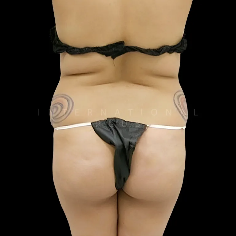 brazilian-butt-lift-bbl-before-after-7 brazilian butt lift bbl before after 7