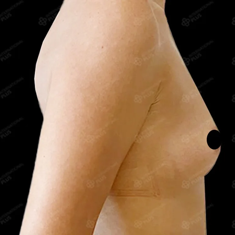 breast-surgery-before-after-11 breast surgery before after 11