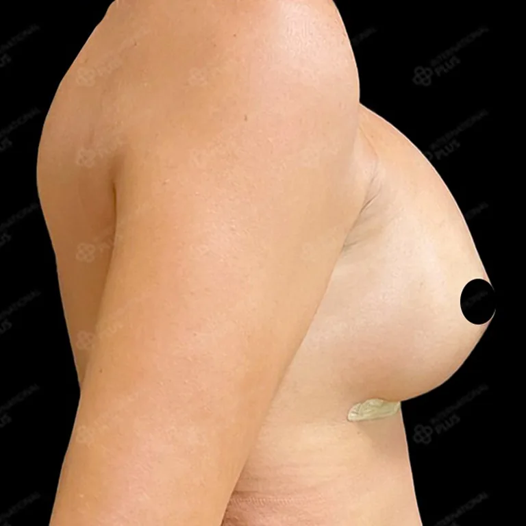 breast-surgery-before-after-12 breast surgery before after 12