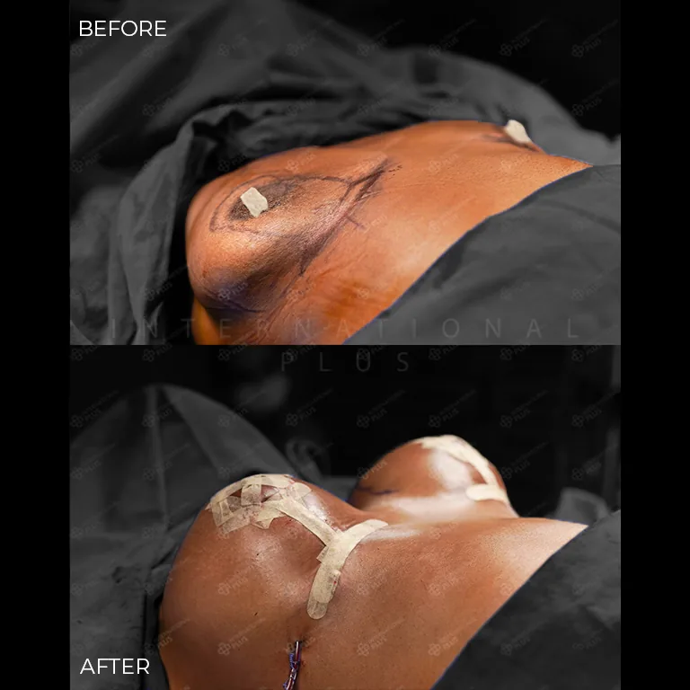breast-surgery-before-after-13 breast surgery before after 13