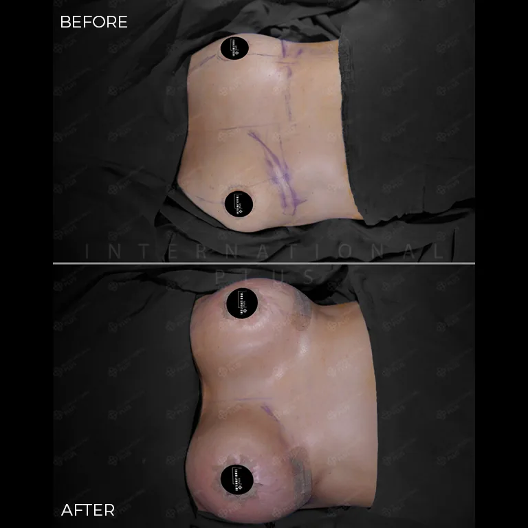 breast-surgery-before-after-14 breast surgery before after 14