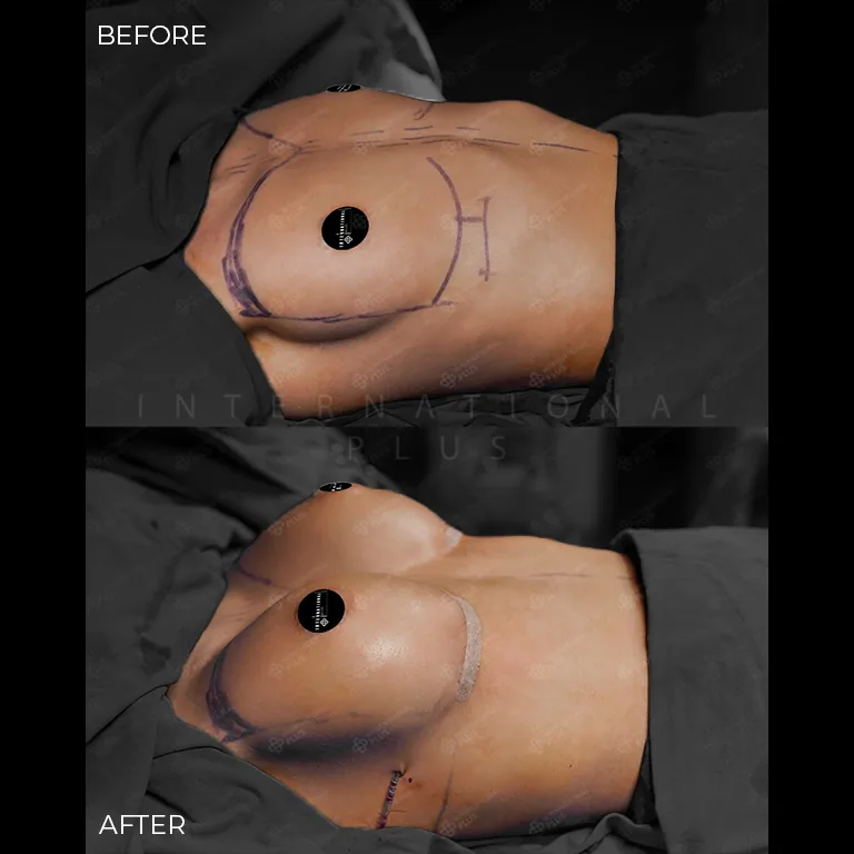 breast-surgery-before-after-15 breast surgery before after 15