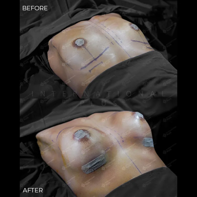 breast-surgery-before-after-16 breast surgery before after 16