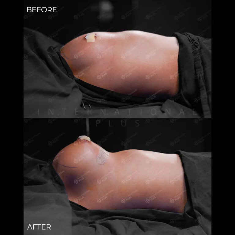 breast-surgery-before-after-18 breast surgery before after 18