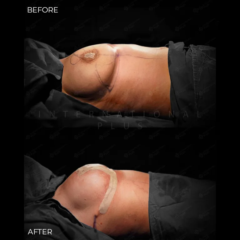 breast-surgery-before-after-19 breast surgery before after 19
