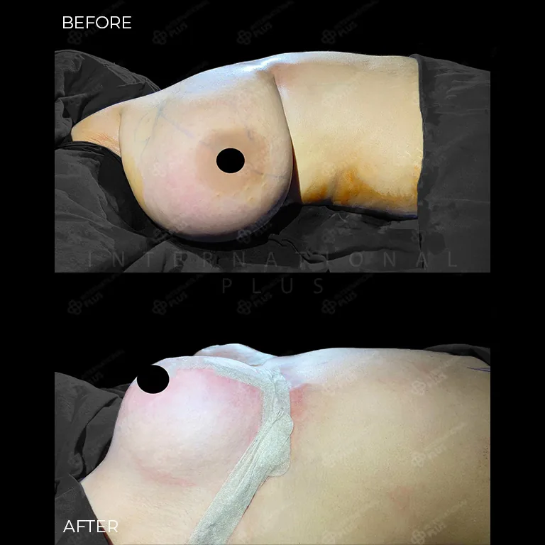 breast-surgery-before-after-20 breast surgery before after 20
