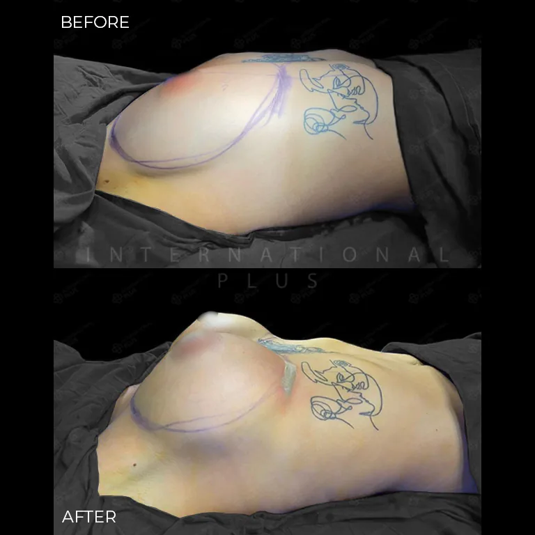 breast-surgery-before-after-27 breast surgery before after 27