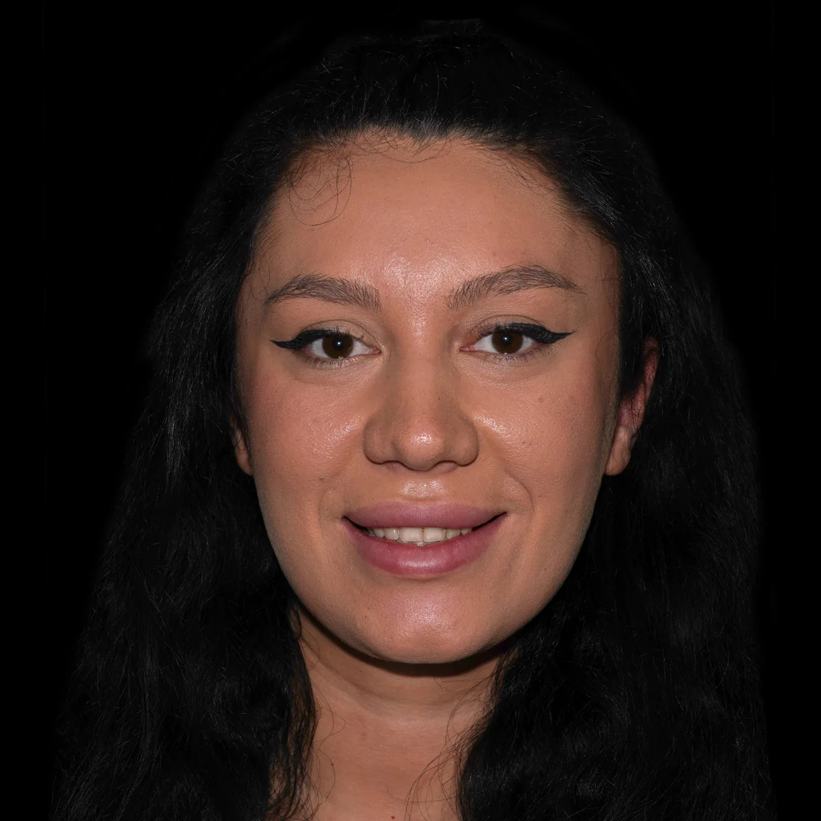 hollywood-smile-before-after-15 hollywood smile before after 15