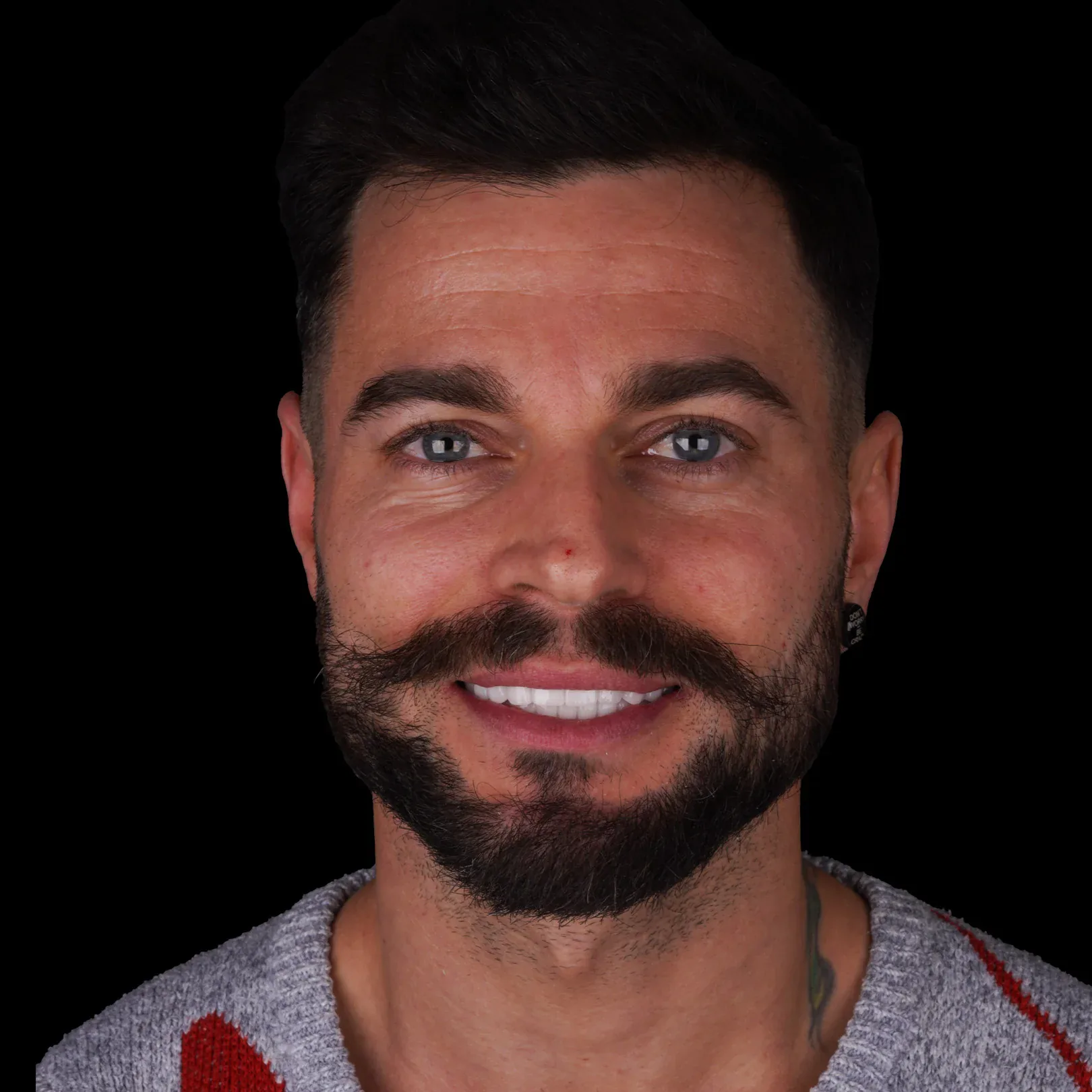 hollywood-smile-before-after-20 hollywood smile before after 20