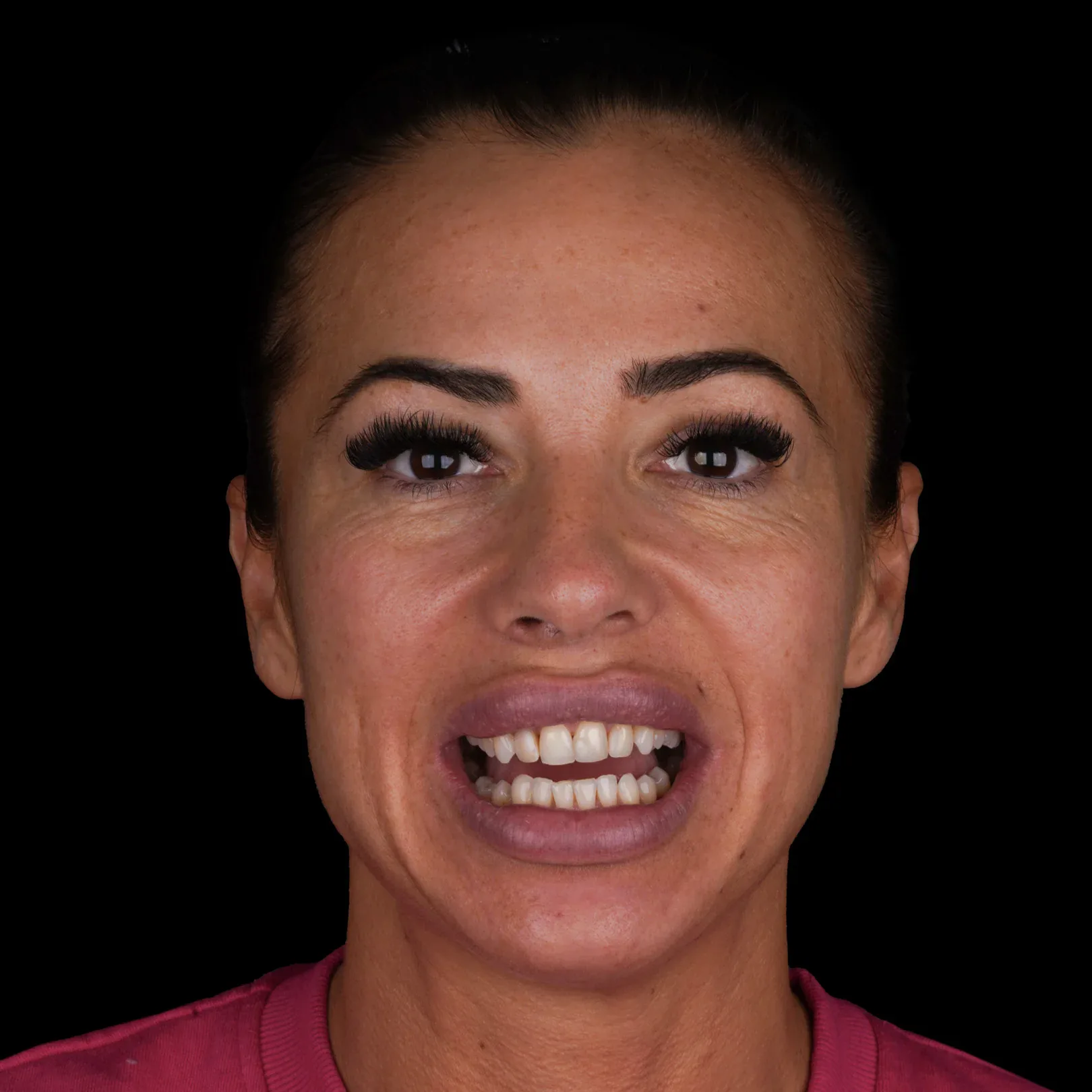 hollywood-smile-before-after-25 hollywood smile before after 25
