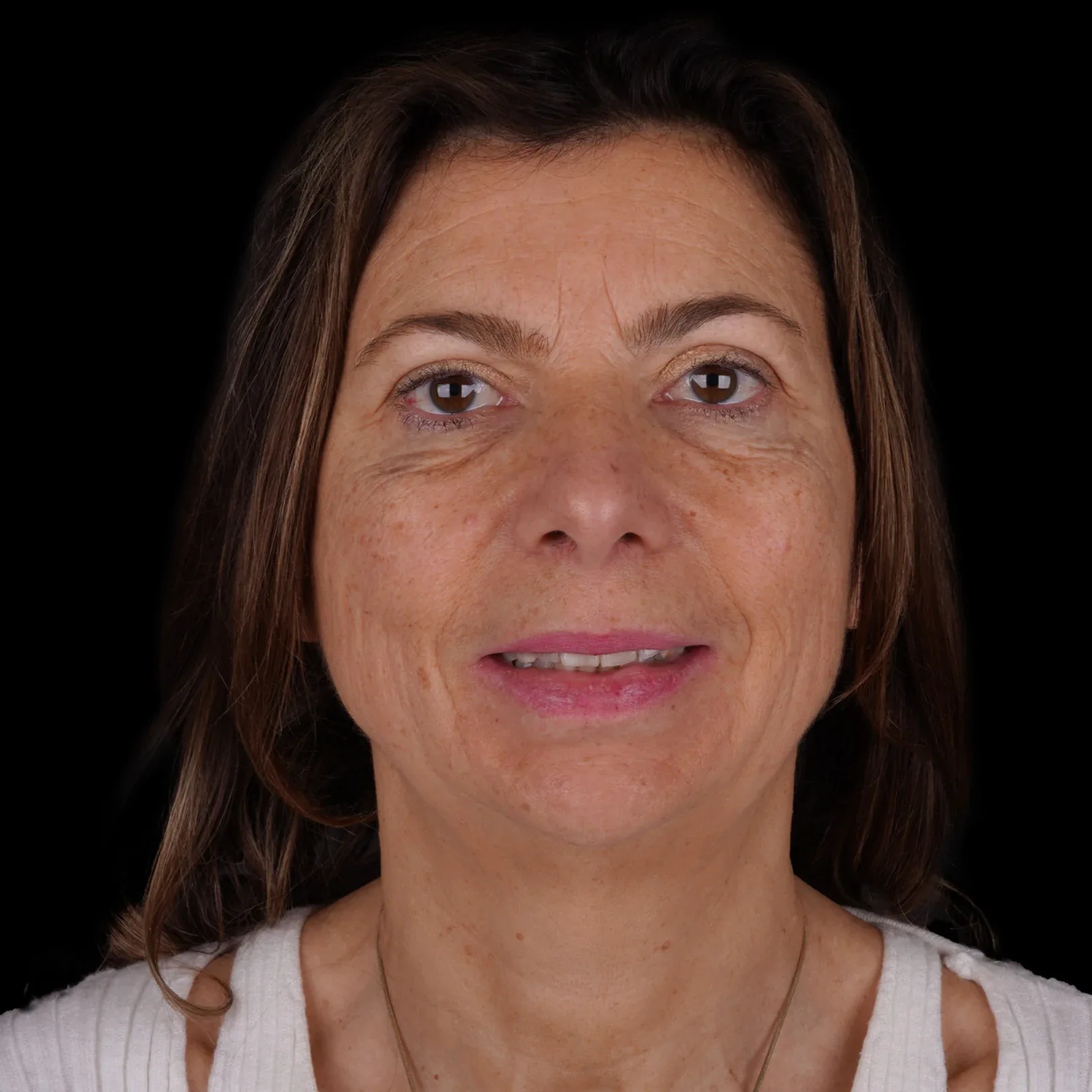 hollywood-smile-before-after-28 hollywood smile before after 28