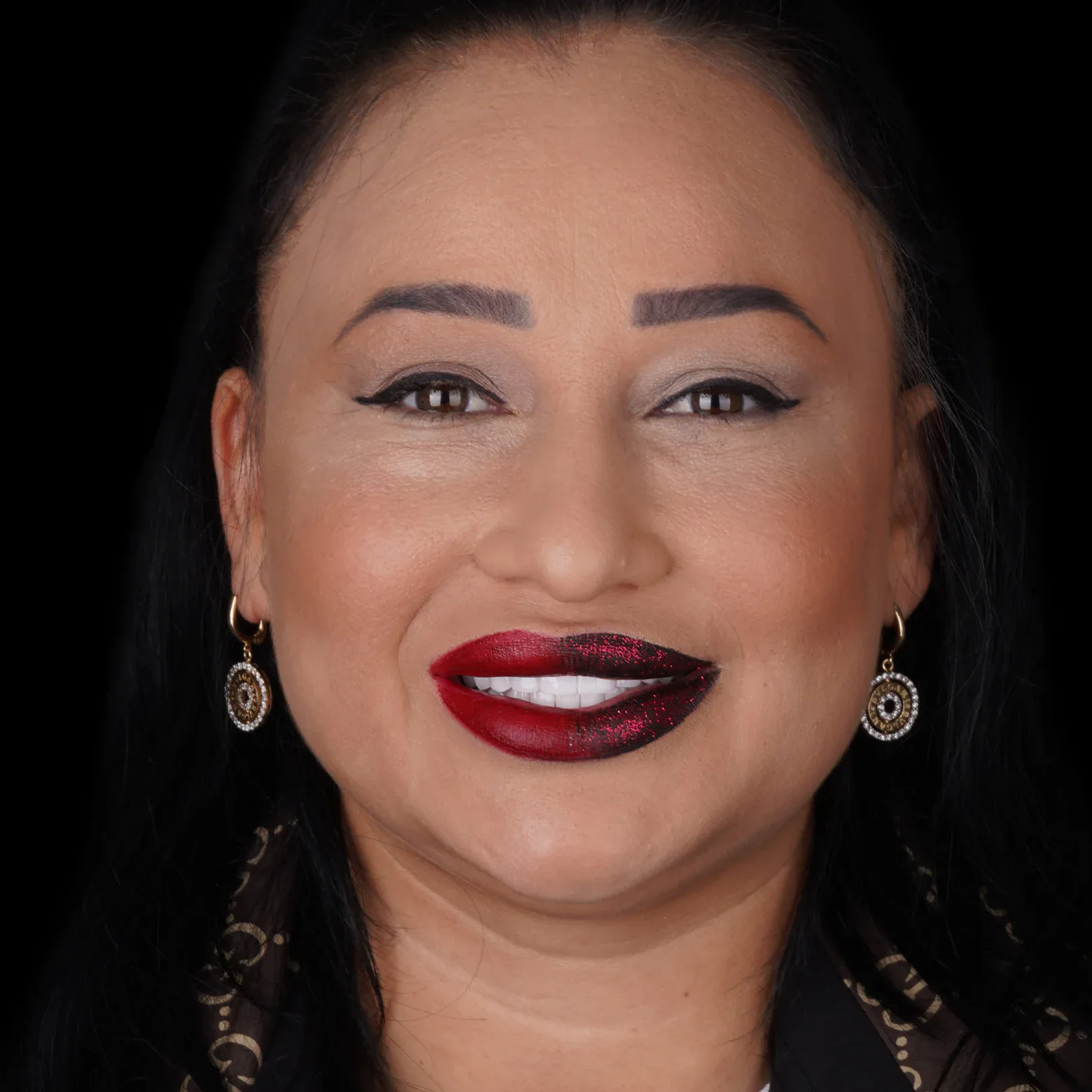hollywood-smile-before-after-30 hollywood smile before after 30