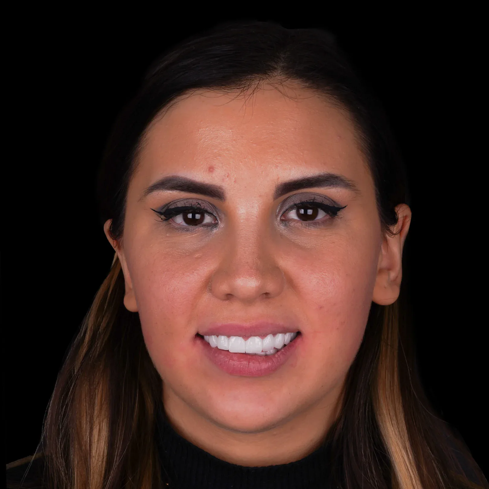 hollywood-smile-before-after-36 hollywood smile before after 36